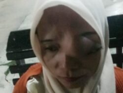 Ira Wati Penderita Tumor Mata Asal Aceh Tamiang Butuh Bantuan Biaya Pengobatan