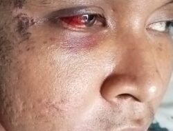 Korban Pengeroyokan Babak Belur di Polsek Pancur Batu Tuntut Keadilan , Adi Lubis: “Hukum Jangan Seperti Pesanan!”